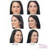 Botox B&A