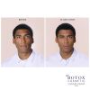Botox Cosmetics B&A