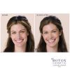 Botox Cosmetics B&A