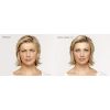 Botox B&A