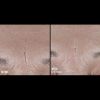 Skinbetter Science® Interfuse® Treatment Face & Neck Cream Before & After