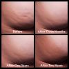Cellfina® Before and After 1