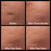 Cellfina® Before and After 1