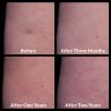 Cellfina® Before and After 1