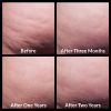 Cellfina® Before and After 1