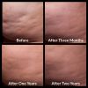 Cellfina® Before and After 1