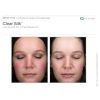 ClearSilk®