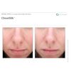 ClearSilk®