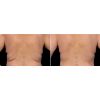 CoolSculpting B&A
