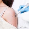 Tattoo Removal