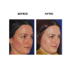 MicroPen before and after   MicroPen Skin Micro Needling Therapy