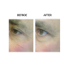 MicroPen before and after   MicroPen Skin Micro Needling Therapy