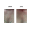 MicroPen before and after   MicroPen Skin Micro Needling Therapy