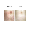 MicroPen before and after   MicroPen Skin Micro Needling Therapy