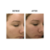 MicroPen before and after   MicroPen Skin Micro Needling Therapy