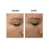 MicroPen before and after   MicroPen Skin Micro Needling Therapy