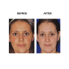 MicroPen before and after   MicroPen Skin Micro Needling Therapy