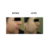 MicroPen before and after   MicroPen Skin Micro Needling Therapy