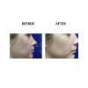 MicroPen before and after   MicroPen Skin Micro Needling Therapy