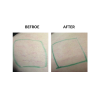 MicroPen before and after   MicroPen Skin Micro Needling Therapy