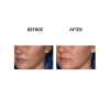 MicroPen before and after   MicroPen Skin Micro Needling Therapy