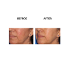 MicroPen before and after   MicroPen Skin Micro Needling Therapy