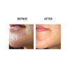 MicroPen before and after   MicroPen Skin Micro Needling Therapy