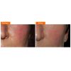 Environ Skin EssentiA® Range Vista-Antioxidant AVST Moisturiser 1 Before & After