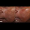 SkinBetter Even Tone Correcting Serum Before & After