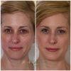 Facial Fillers
