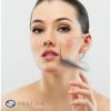 Forever Young BBL™ Treatment
