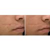 Laser Scar Revision Consultation