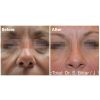 Fractora™ Before & After 6