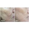 Fractora™ Before & After 1