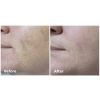 Fractora™ Before & After 4