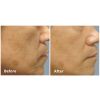 Fractora™ Before & After 10