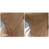 Fractora™ Before & After 2