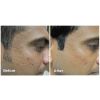 Fractora™ Before & After 9