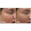 Fractora™ Before & After 8