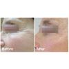 Fractora™ Before & After 3