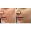 Fractora™ Before & After 5