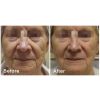 Fractora™ Before & After 7