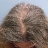 Hair Loss After