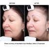 Halo Before and After Three