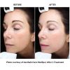 Halo Hybrid Fractional Laser (4 options + 1 Add On)