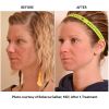 Halo Before and After Two