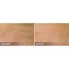 HydraFacial B&A