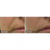 HydraFacial B&A