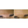 HydraFacial B&A