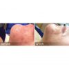 HydraFacial B&A